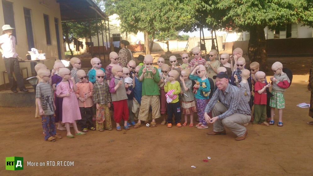 Albinos in Tanzania live in special camps