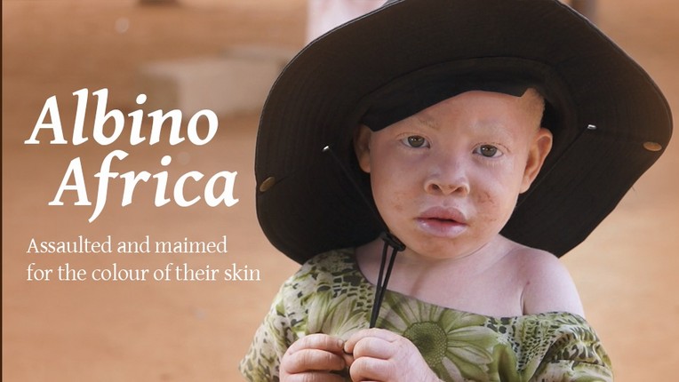 Albinos In Tanzania Documentary — Rtd